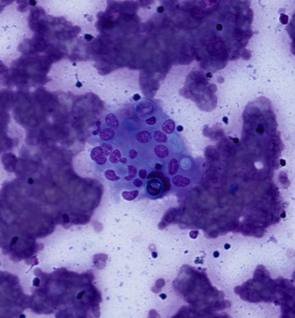 granulomatous-lymphocytic-cells