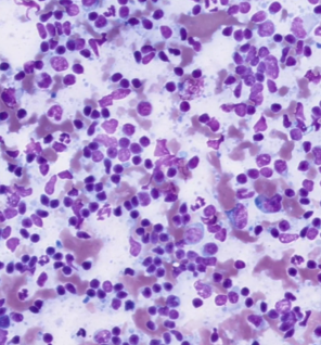 reactive-lymphoid -hyperplasia